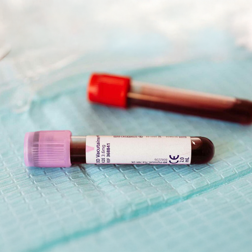 Blood sample in a laboratory tube with a purple cap lies on a medical pad.